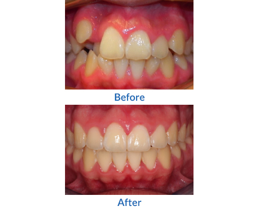 Crooked teeth before and after image 2