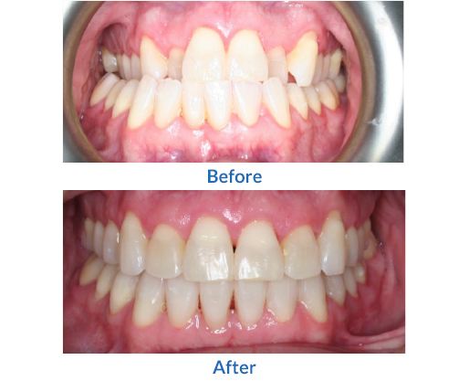 A before and after image of braces