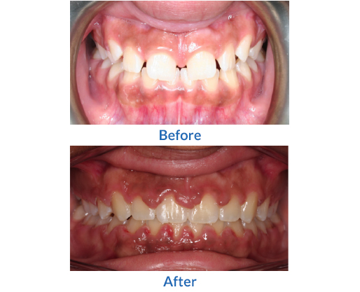 Another example of before and after braces